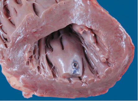 pericarditis was a manifestation of disseminated aspergillosis.