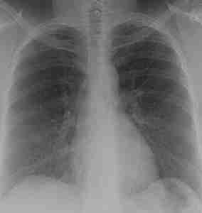 Chest x-ray of normal  patient mold infection free.